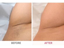 ララ(RARA)の雰囲気（わきWax+光脱毛でチクチク卒業～☆）