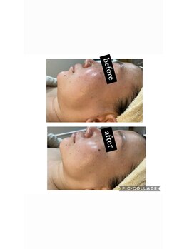 シャルム(CHARME)/ハーブピーリング＋小顔コース