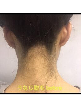 カミユイ(Kamiyui)/うなじ脱毛
