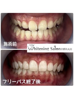 ホワイトニングサロン 京都烏丸店/ホワイトニング施術例