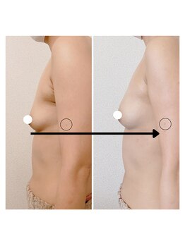 スノーフレーク(snow flake)/産後下垂、デコルテの削げ解決★