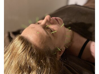 ハリルル 併設 GLケンタ鍼灸整骨院(HARILULU)/肌質改善に美容鍼