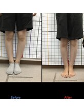 きずな鍼灸整骨院 光の森院/長年O脚が気になっていたお客様