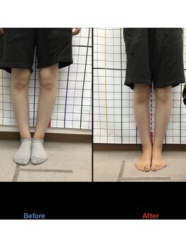 きずな鍼灸整骨院 光の森院/長年O脚が気になっていたお客様
