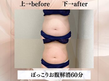 イヨヨ(iyoyo)/【痩身】 Before After