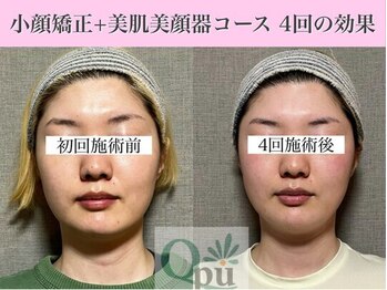 キュープ 福岡大牟田店(Qpu)/小顔矯正4回コースの変化