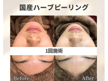 イーラボ 池袋店(e-LABO)/大人気!国産ハーブピーリング