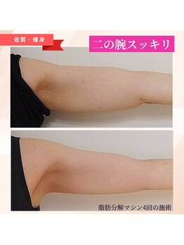 ユニクリア 佐賀(Uniclear)の写真/今すぐどうにかしたい!二の腕スッキリ【短期集中4回プラン】登場!速攻痩身!