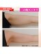 ユニクリア 佐賀(Uniclear)の写真/今すぐどうにかしたい!二の腕スッキリ【短期集中4回プラン】登場!速攻痩身!