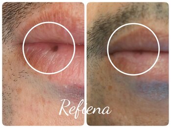 クリニカルエステ リフィーナ 西荻窪店/唇の悩み、さよなら //