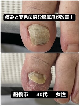 巻き爪じゅん 千葉駅前店/肥厚爪による痛みと変色が改善