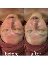 クオコア(KUOKOA)/大人気の毛穴洗浄フェイシャル。