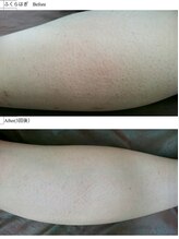 ヴィオール 名古屋栄店(VIOR)/【レデイース脱毛】　ふくらはぎ