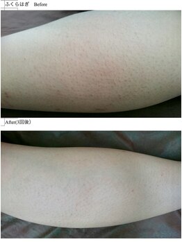 ヴィオール 名古屋栄店(VIOR)/【レデイース脱毛】　ふくらはぎ