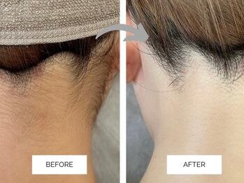 リンネ(Rin'ne)/[部分脱毛] うなじ美人へ♪