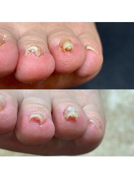 リリ(lili)/巻き爪矯正+ネイルケア1回目