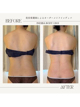 エスプリ(Esprit+)/●インディバ施術効果