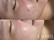 ホワイトアクア 京都店(WHITE AQUA)/ハーブピーリング/毛穴/京都