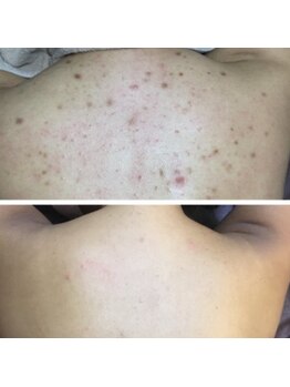 ココ 梅田中津(COCO.)/背中＊ハーブピーリング