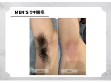 アルゴ 福津店(ALGO)/【メンズ】ワキ脱毛