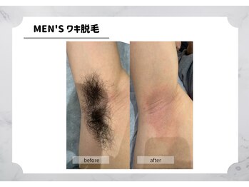 アルゴ 福津店(ALGO)/【メンズ】ワキ脱毛