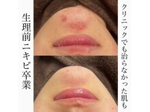 リッチ(Rich)の雰囲気（他施術を繰り返しても駄目だった肌も、生理前ニキビ卒業！）