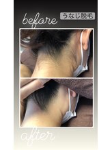 ツリービューティー(Tree Beauty)/★うなじ脱毛★