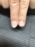 【スカルプ】深爪矯正コース 6980円