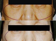 フルリール/【メソポレーションケア】