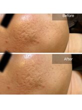 フルブルーム(Full Bloom)/ララピール/1回でこの仕上がり