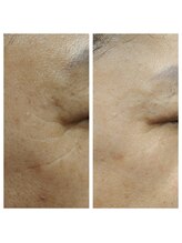 モアサロン(MOA salon)/小じわ改善ビフォー