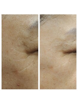 モアサロン(MOA salon)/小じわ改善ビフォー