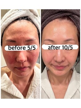 ミエル(miel)/肌の赤み・敏感肌ケア