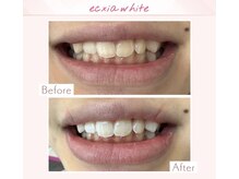 エクシアホワイトニング 天王寺店/ホワイトニングビフォーアフター