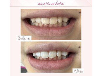 エクシアホワイトニング 天王寺店/ホワイトニングビフォーアフター