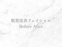 リライン(ReLine)/【肌質改善フェイシャル】