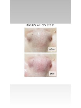 アエリ(AERI)/before ～after 
