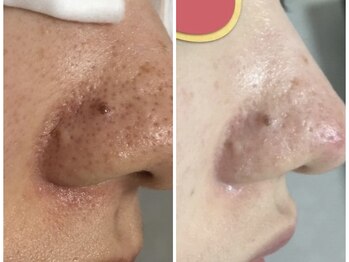 ニコ アンド キャンディー(Nico.&Candy)/気になる毛穴の汚れスッキリ☆