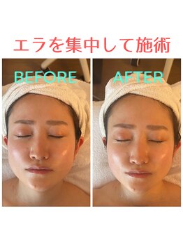 パルフェット(parfaite)/エラ張りさんにオススメ