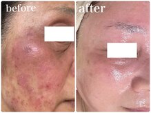 本気で肌荒れに悩む方に、国産漢方ハーブピーリングでリセット！