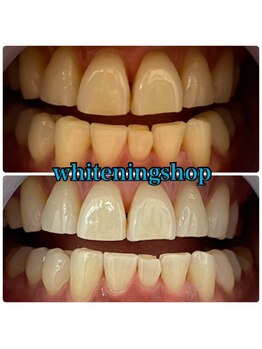 ホワイトニングショップ 山形店(Whiteningshop)/山形の学生多数ご来店