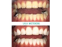 ララホワイトニング
