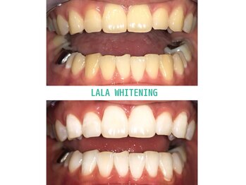ララホワイトニング