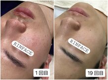 メンズにも人気のフェイシャルサロン♪毛穴/ニキビ/エイジング