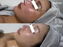 ナチュールムーン(Nature moon.)/ハーブピーリング