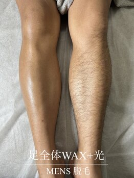 ディア(Dea)/メンズ脚脱毛