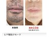 【ヒゲ脱毛】白髪ヒゲもOK！W照射ヒゲ脱毛¥9,000【都度払い】