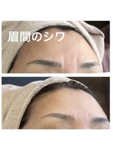 ココ 梅田中津(COCO.)/眉間のシワ