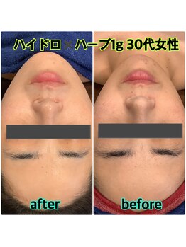 リソル(RISOL)/REVIハーブピーリング×ハイドロ