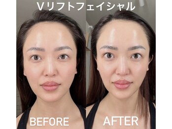 クラン(CLAN)の写真/【WINBACK『Vリフトフェイシャル』】高周波の活性力でハリのある引き締まったお肌へ！リフトアップ効果◎